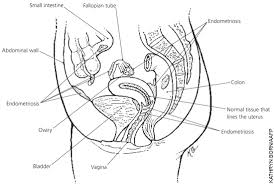 Each month, this tissue responds to the monthly menstrual cycle in the same way as the lining of the womb. Endometriosis What You Should Know American Family Physician