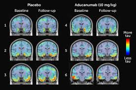 By doing so, biogen hopes to slow the cognitive decline for alzheimer's patients. The Once Scrapped Alzheimer S Drug Aducanumab May Work After All Science News