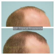 We know this can feel like a very long time when you want to. This 27 Year Old Gentleman Is Shown Before And Five Months After Starting Topical Finasteride With Outstanding Results Minoxidil Topical Facial Plastic Surgery