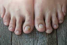 Image result for Onycholysis feet
