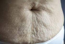 How To Tighten Belly Skin After Delivery