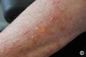 Image result for Pemphigoid