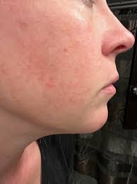 Itchy skin /back, arms, legs/ and skull for months. Can you recommend some  natural remedies please? Or give me some advice. Not dry and flakey skin,  something else...thank you