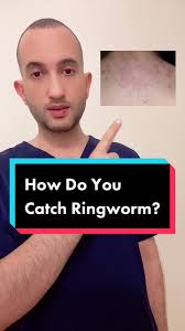 To learn more about #ringworm 👉🏻@Dr Ibrahim Salman @Dr Ibrahim Salman