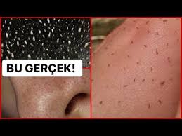 Bildigin Her Seyi Unut Aninda Ne Var Ne Yok Temizliyor Siyah Nokta Yag Butonu Leke Sivilce Youtube