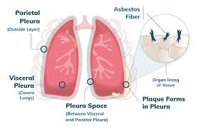 mesothelioma symptoms, diagnosis , staging and clinical trials are also covered. Pleural Mesothelioma Stages Treatment Prognosis