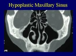 Image result for Maxillary Sinus