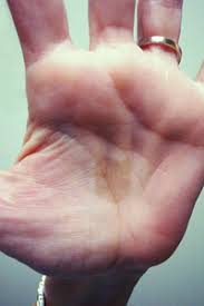 The coloring pigment called melanin determines the color of your skin. Discoloration On Palm That Won T Wash Off