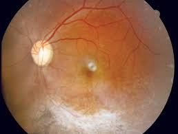 Image result for HIV Retinitis