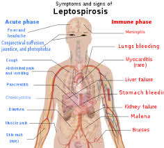 Weil's disease, the acute, severe form of leptospirosis, causes the infected individual to become jaundiced (skin and eyes become yellow), develop kidney failure, and bleed. Leptospirosis Wikipedia