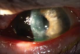 Most of these studies used plasmid dna. A Primer On Herpes Simplex Keratitis