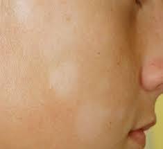 Panau adalah jangkitan yang kerap berlaku pada lapisan luaran kulit disebabkan oleh kulat ★gunakan sabun pencuci muka semasa mencuci muka ★pastikan badan telah dilap dengan. Tips Merawat Panau Secara Semulajadi