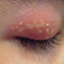 Herpes Simplex Goz Ucugu Op Dr Fersat Muhacir