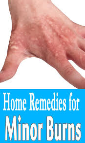 9 Home Remedies For Minor Burns Styles At Life