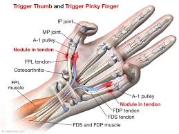 Calcification of the supraspinatus tendon is a major contributor to shoulder pain in the general population and is often worsened following a supraspinatus tear. Tendon Rupture Following Trigger Finger Release Medmovie Com