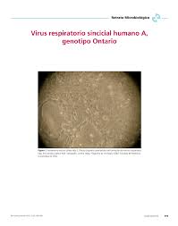 La mayoría de los niños ha tenido esta infección hacia la edad de 2 años. Pdf Virus Respiratorio Sincicial Humano A Genotipo Ontario