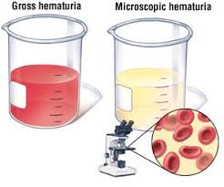 Doctors first try to establish that bleeding is the cause of red urine. Hematuria Guide Causes Symptoms And Treatment Options