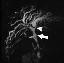 Maybe you would like to learn more about one of these? Imaging Features Of Primary Sclerosing Cholangitis From Diagnosis To Liver Transplant Follow Up Radiographics