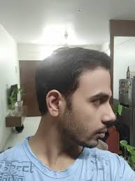 good results good service igraft global hair services chinchwad pune consumer review mouthshut com mouthshut com