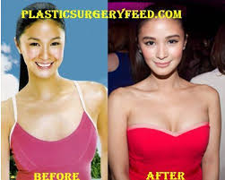Heart evangelista is a 36 year old filipino actress. Heart Evangelista Breast Implants Boobs Job Plastic Surgery Feed