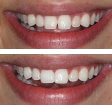Aug 20, 2018 · dr eskander charges from £200 per tooth, but remember you don't need to have every tooth done, because as she says 'you really only see the front four teeth anyway.' where should you go for teeth. Composite Bonding Preston Helping You Achieve A Smile You Re Happier With Without Causing Damage To Your Teeth