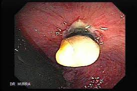 Image result for hemorrhoids