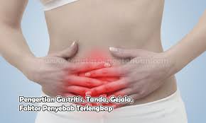 Gastritis merupakan penyakit yang sering kita jumpai dalam masyarakat maupun dalam bangsa penyakit dalam. Pengertian Gastritis Tanda Gejala Faktor Penyebab Lengkap
