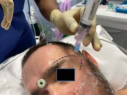 Image result for Forehead Regional Block