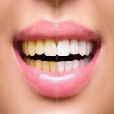Teeth Whitening Training for Experts - Master Professional Skills – Luxe  Beauty & Body Co.