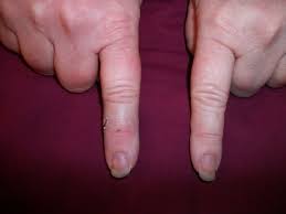 We did not find results for: Preventing Infection After Dog Bite Hubpages