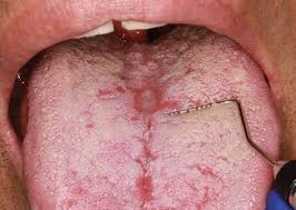 Image result for Candidiasis