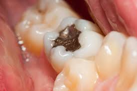 What can i eat after tooth filling? My Tooth Filling Fell Out What To Do Wilkinson Dental