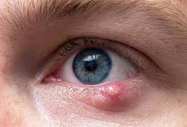 The cavity is irrigated with sterile saline, packed with gauze, dressed, and bandaged. How To Get Rid Of A Stye 8 Home Remedies And Treatments