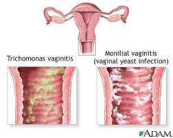 Do i have a yeast infection? Causes Of Vaginal Itching Medlineplus Medical Encyclopedia Image