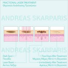 Η laser αποτρίχωση μπικίνι αποτελεί δημοφιλή επιλογή για τις γυναίκες ενώ το στήθος και η πλάτη αποτελούν περιοχές που επιλέγουν συχνότερα οι άνδρες. Laser Anaplashs Toy Proswpoy Dr Andreas Skarparis