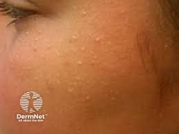 Image result for red rash face