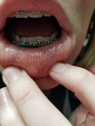 How to use a floss threader. The Coil Won T Be So Bad The Orthodontist Said Braces
