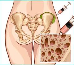 This is a common question and one that cannot be answered definitively. Finding The Best Donors For Bone Marrow Transplantation Onco Com