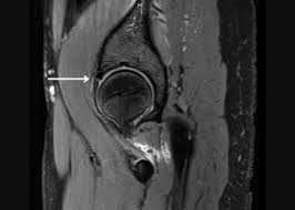 Image result for Hip Labral Tear