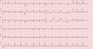 Emdocs Net Emergency Medicine Educationsubtle Ecg Findings In Acs Part I Left Main Coronary Artery Disease Emdocs Net Emergency Medicine Education