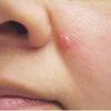 This type of skin cancer can be easily treated during its early stage of development. 3