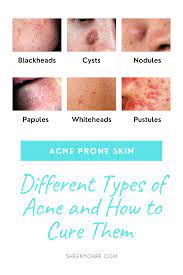 Different Types Of Acne And How To Treat Them In 2021 Types Of Acne Different Types Of Acne Pimple Types
