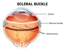 Image result for Sclera