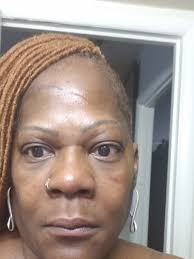 PRP and Juverderm fillers