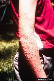 Image result for Fire Ant Sting