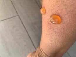 Image result for Papular urticaria