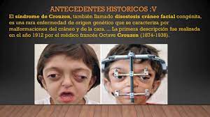 We did not find results for: Sindrome De Crouzon Hecha Por Mane He Youtube