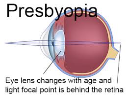 Image result for Presbyopia