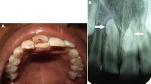 We did not find results for: Clinical Consequence Of Mesiodens A Case Series Sciencedirect