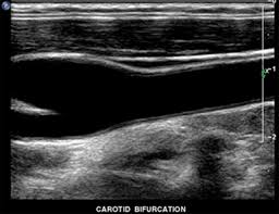 His family has a history of heart disesae in their background. Carotid Artery Disease Frenchs Forest Angioplasty Stent Placement Nsw